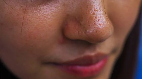 Jerawat di Dahi: 6 Penyebab dan Cara Cepat Menghilangkannya - Jenis Kulit Berminyak