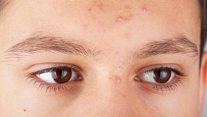 Jerawat di Dahi: 6 Penyebab dan Cara Cepat Menghilangkannya - Featured Image